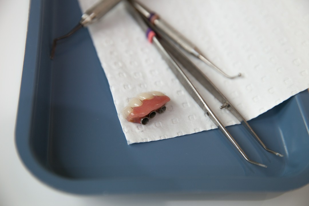 Kiedy stosuje się mosty na implantach?
